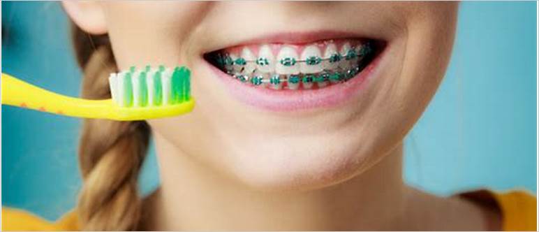 Braces cost for kids